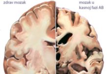 Kineskim slučajem uzroci Alzheimerove bolesti pali u vodu!?