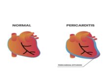Cjepivo je uzrok upale tanke membrane koja okružuje i štiti naše srce