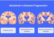 Ciljani zvučni valovi i prirodna snaga mozga za izlječenje Alzheimerove bolesti