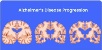 Ciljani zvučni valovi i prirodna snaga mozga za izlječenje Alzheimerove bolesti