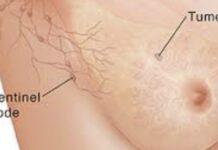 Reishi gljiva može pomoći u usporavanju rasta stanica raka dojke