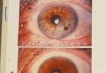 Šarenica – karta fizičkog stanja osobe