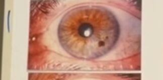 Šarenica – karta fizičkog stanja osobe